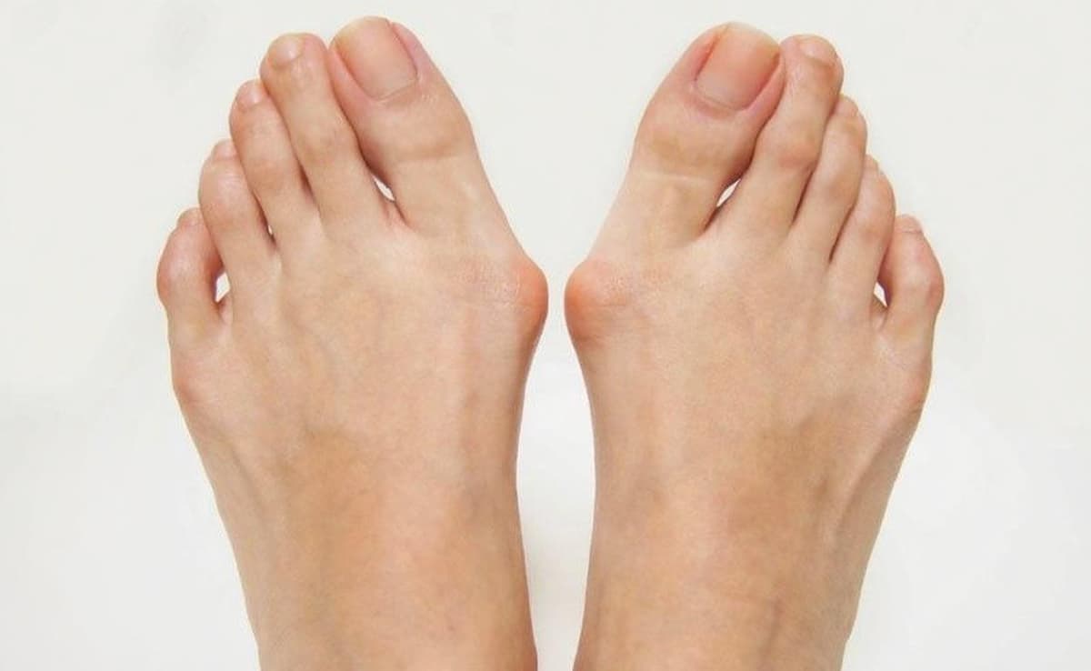 Bunion Surgery